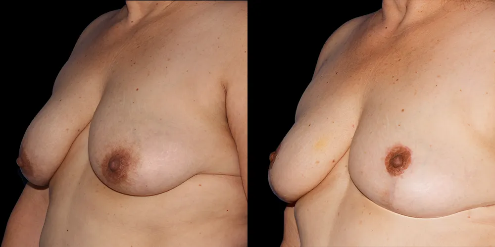 mastopexy-02_02