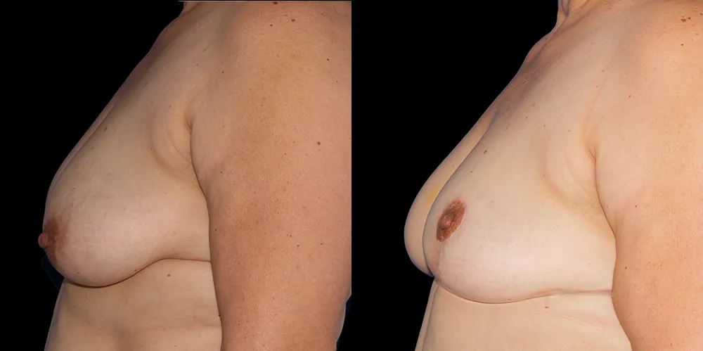 mastopexy-02_03