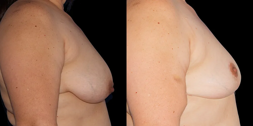 mastopexy-02_05