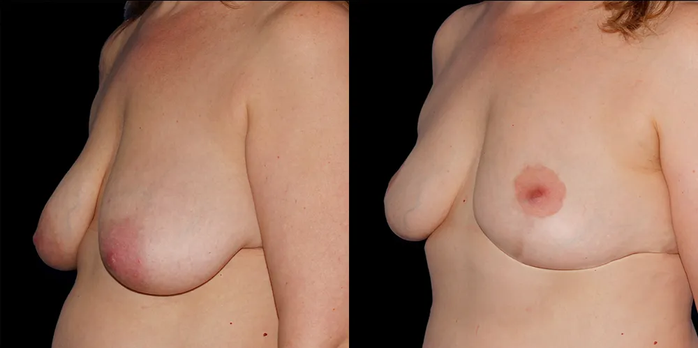 mastopexy-03_02
