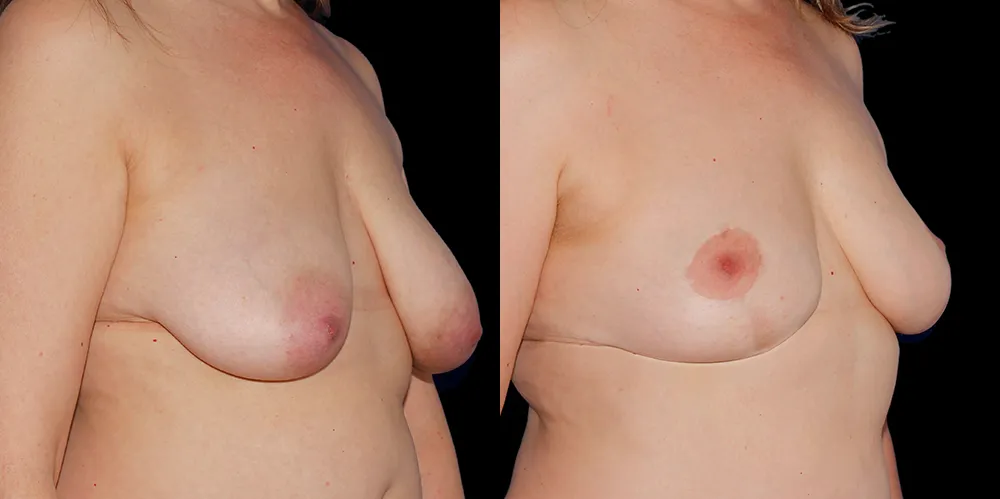 mastopexy-03_05